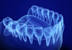 Image of dental crowns in an MRI