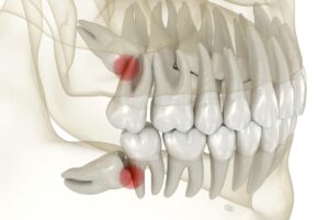 concept of why do wisdom teeth cause pain