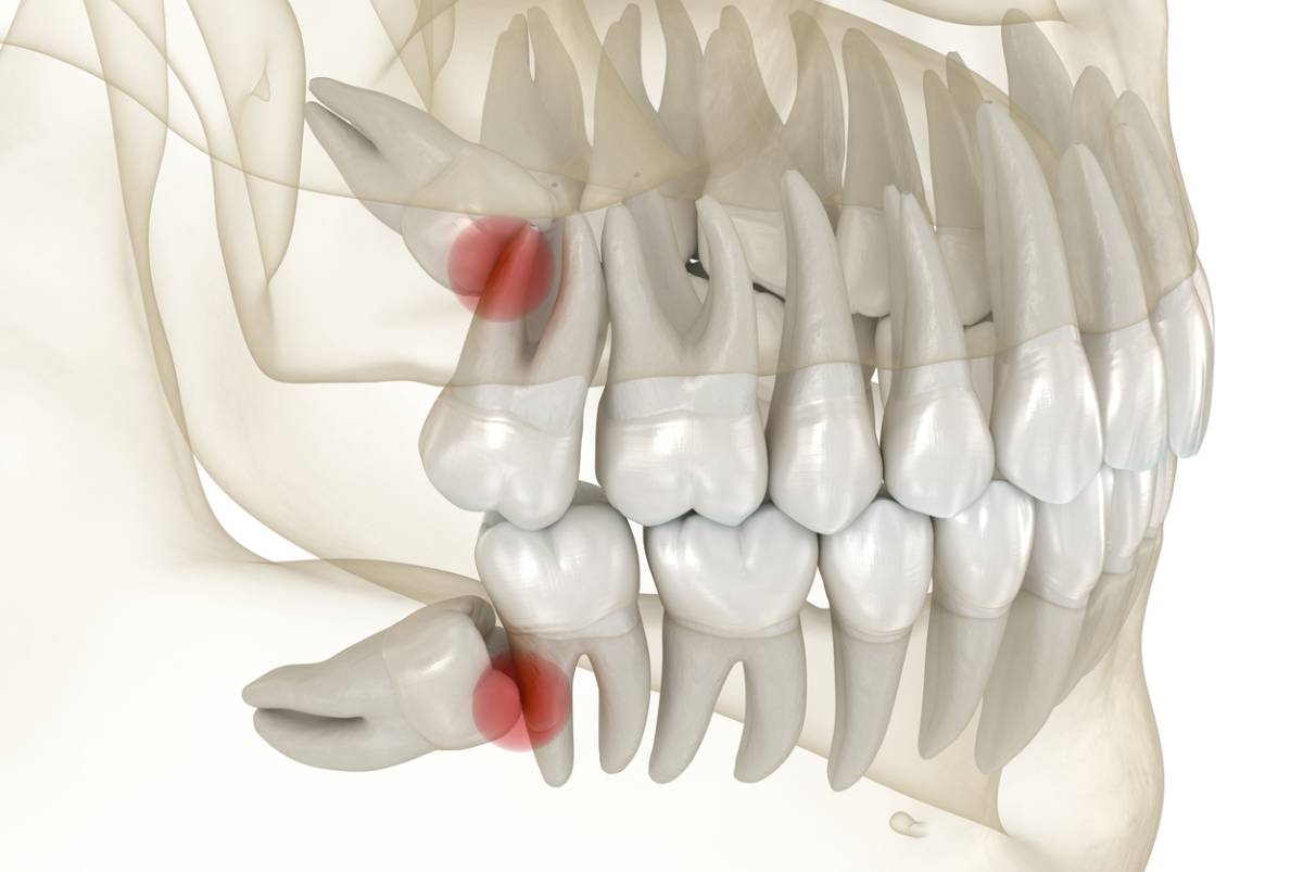 Why Do Wisdom Teeth Cause Pain Monte Vista Dental Group Blog