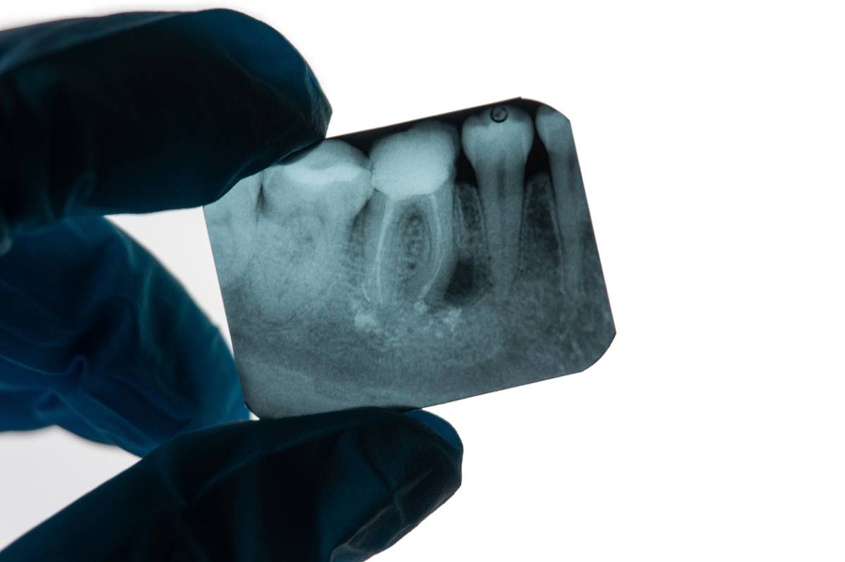 featured image for root canal before a crown