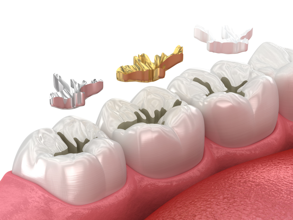 concept for what are dental fillings made out of