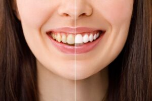 concept for how to maintain teeth whitening results