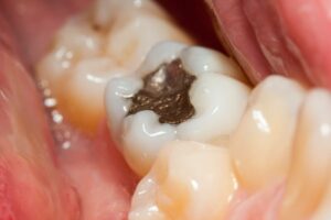 Featured image for How Long Do Dental Fillings Last?