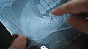 Featured image for When Do Wisdom Teeth Come In?