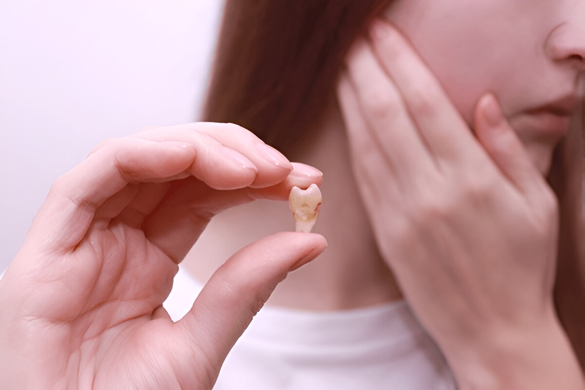 wisdom tooth cavity